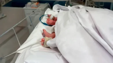 Gêmeos siameses morrem em Goiânia dias antes de cirurgia rara de separação